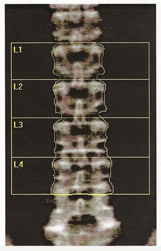 does actonel increase bone density